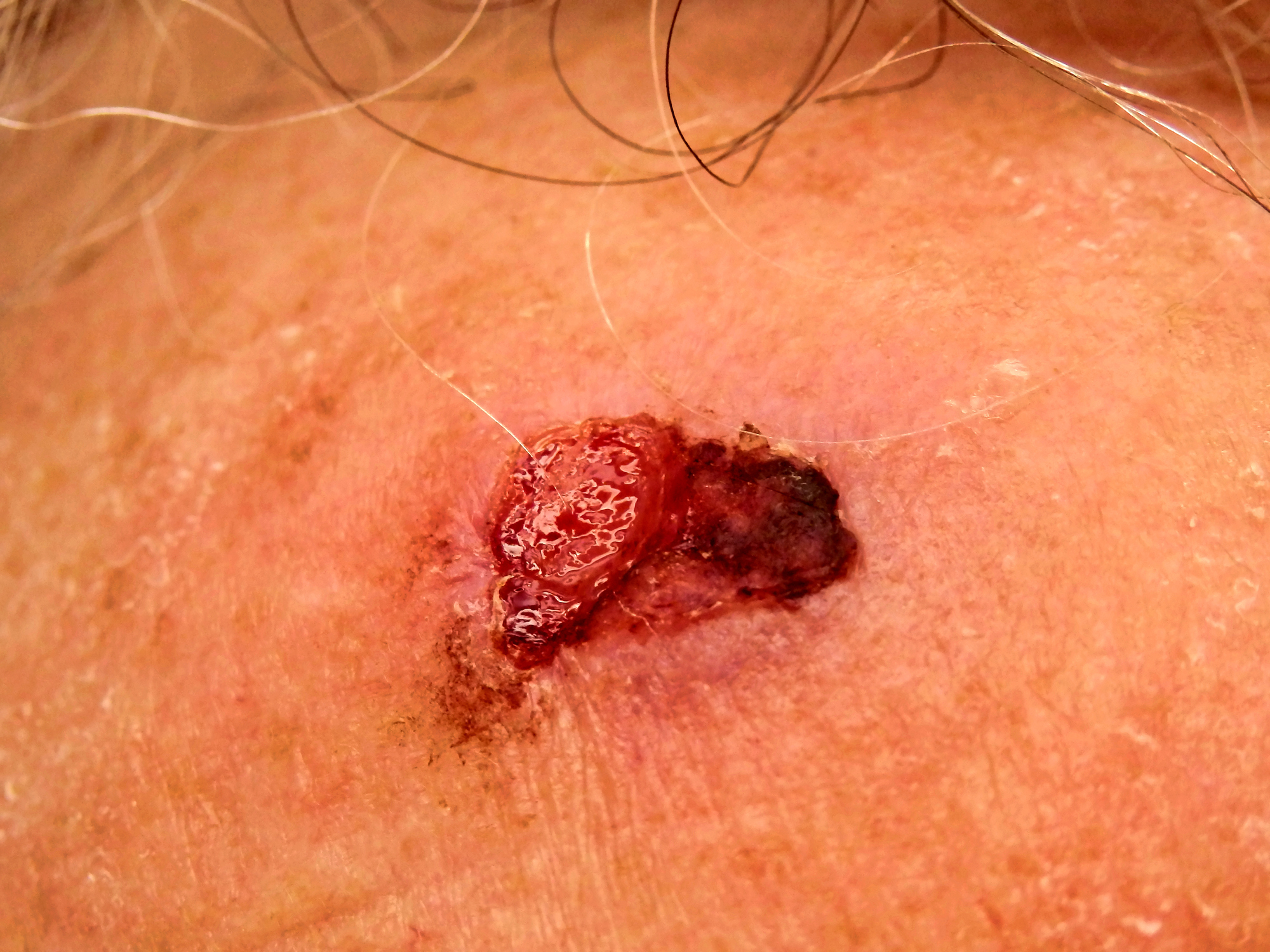 Squamous Cell Carcinoma in Palm Beach Gardens & Stuart, FL