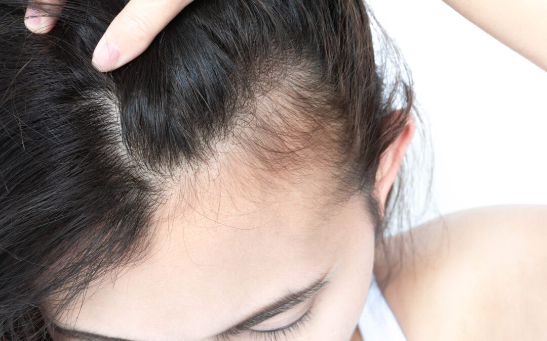 Can Oral Minoxidil Help Hair Loss?