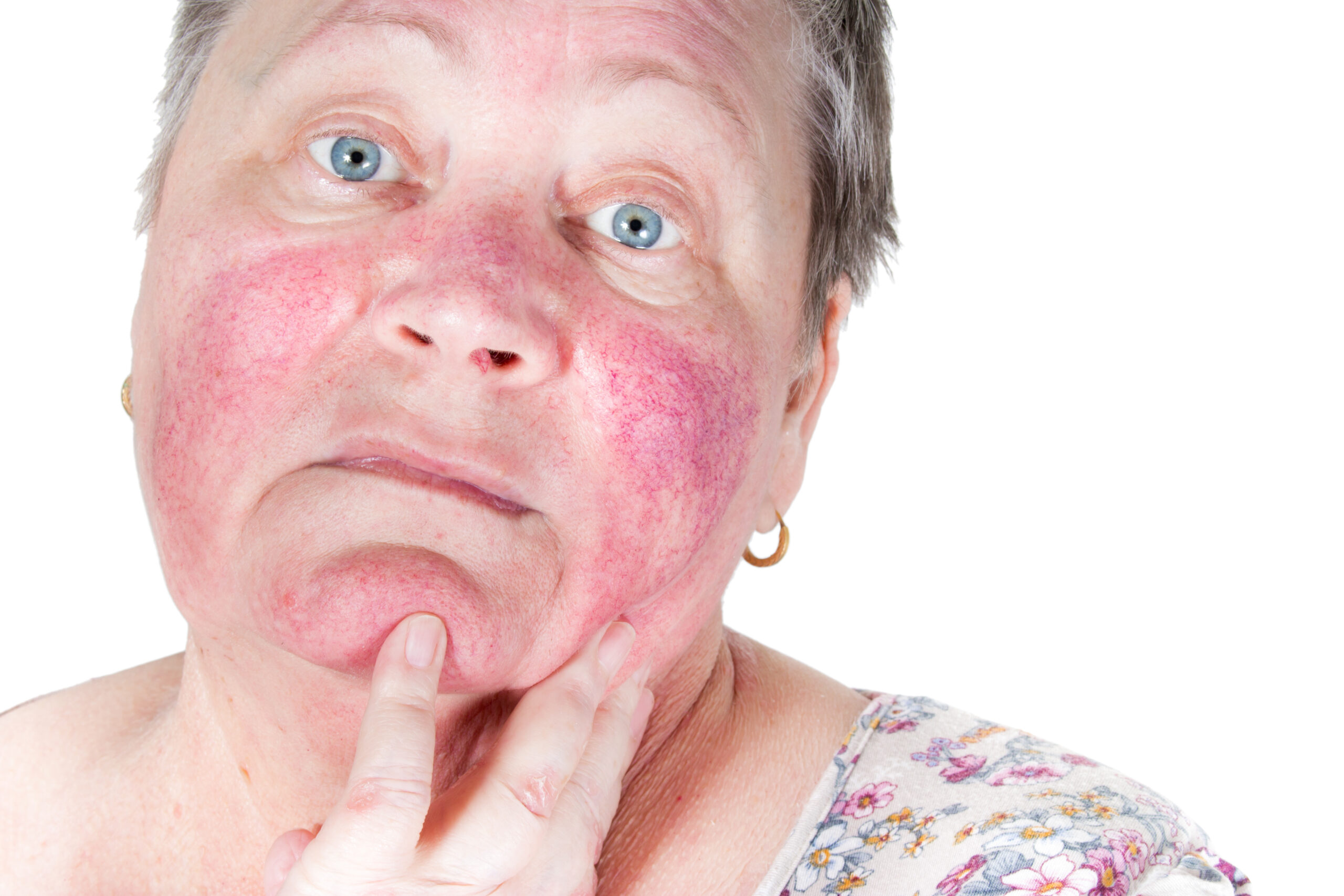 Rosacea is a chronic skin condition characterized by redness, flushing, and the development of visible red blood vessels on the face, in addition to acne-like pustules.