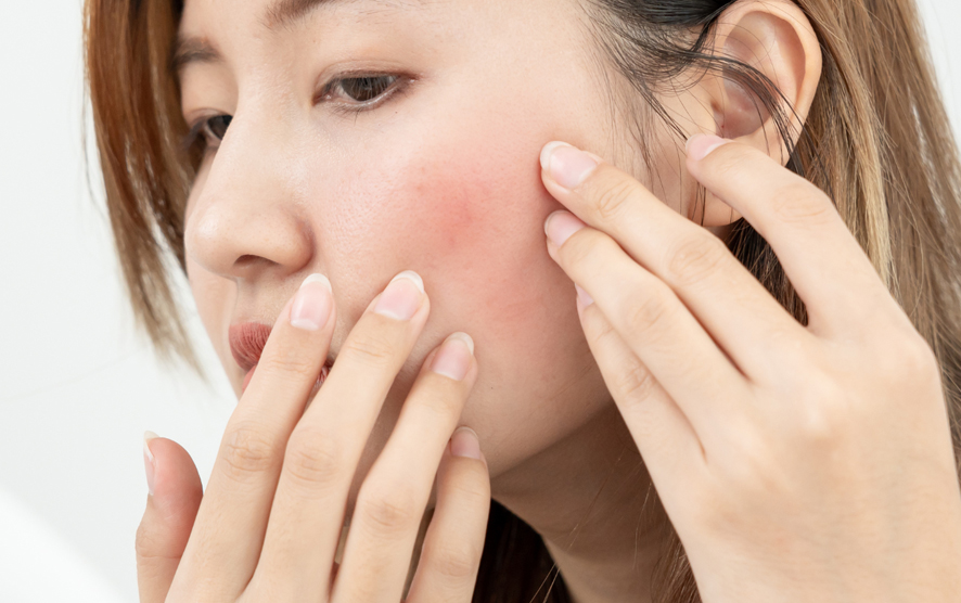 Understanding Rosacea: Causes, Symptoms, and Treatment Options